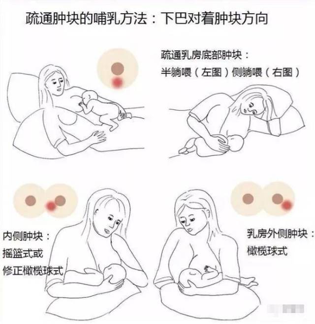 产后涨奶，疼痛难忍怎么办？